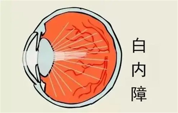 上海醫(yī)大眼科白內(nèi)障手術(shù)8千-3萬起，不同品牌晶體價格有些許差異