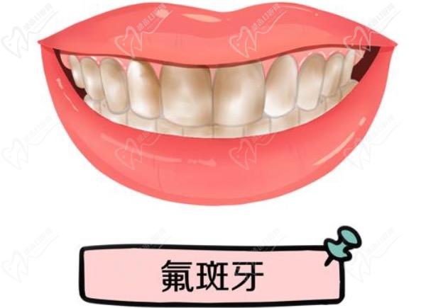 氟斑牙是什么原因造成的？