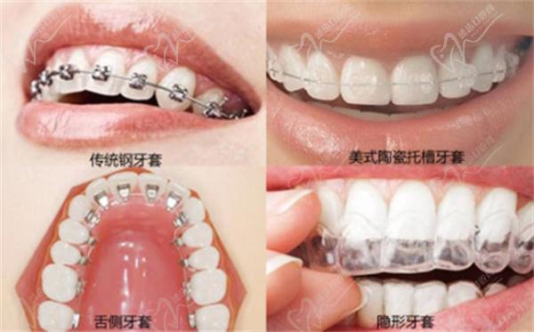 寧波陌客爾口腔牙齒矯正怎么樣價格貴嗎？