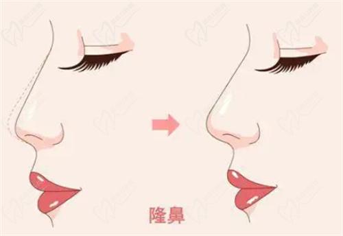 毛運(yùn)春醫(yī)生做鼻子怎么樣？