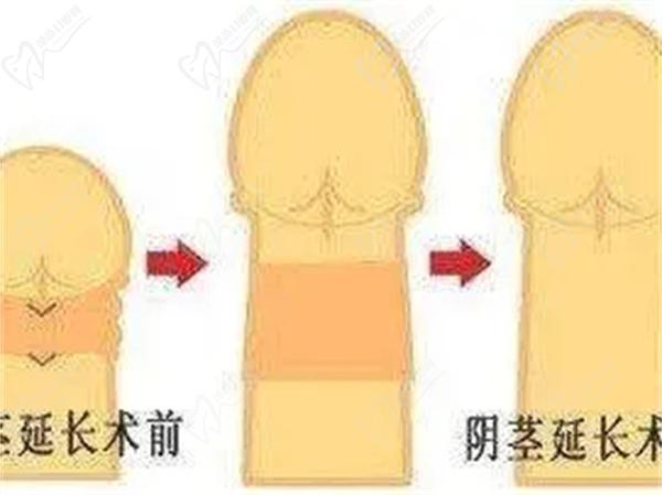 國內玻尿酸增粗多少錢