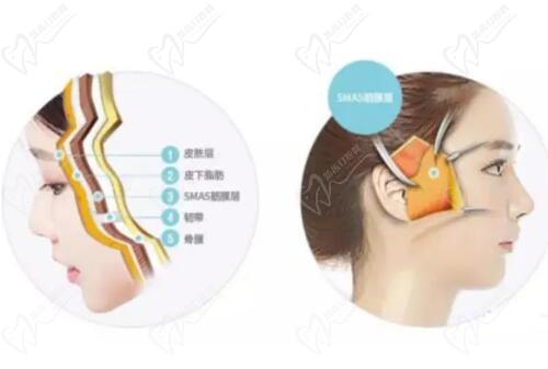 劉遠程無痕筋膜提升技術(shù)優(yōu)勢