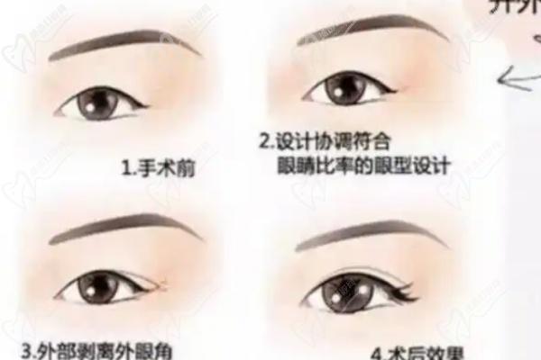 周美蘭的雙眼皮是什么樣的