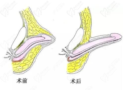 李世榮的延長術(shù)采用"三層遞進(jìn)減張縫合"技術(shù)