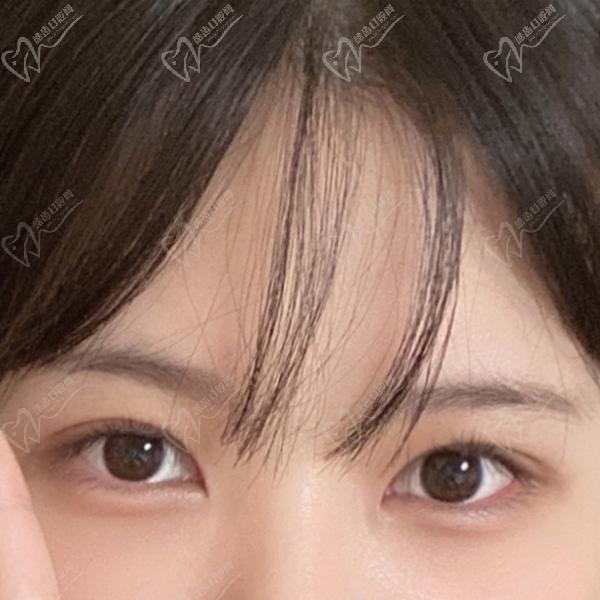 沈陽(yáng)雙眼皮修復(fù)哪位醫(yī)生好