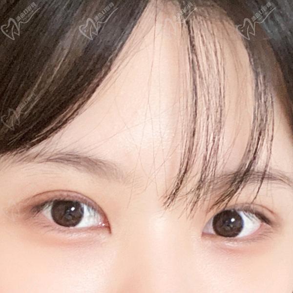 沈陽(yáng)雙眼皮修復(fù)哪位醫(yī)生好