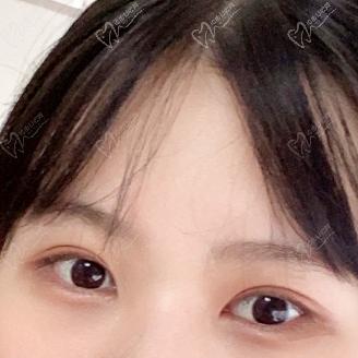 沈陽(yáng)雙眼皮修復(fù)哪位醫(yī)生好