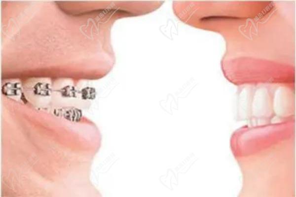 怎么區(qū)分正畸mbt與roth托槽？對(duì)比兩者區(qū)別來看哪個(gè)好附價(jià)格