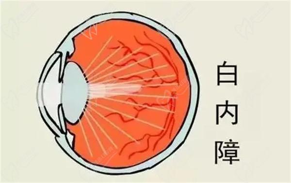 上海醫(yī)大眼科白內(nèi)障手術(shù)8千-3萬(wàn)起，不同品牌晶體價(jià)格有些許差異